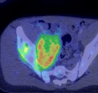 Figure 5 for case Ewing Sarcoma
